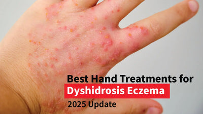 Best Hand Treatments for Dyshidrosis Eczema: 2025 Update
