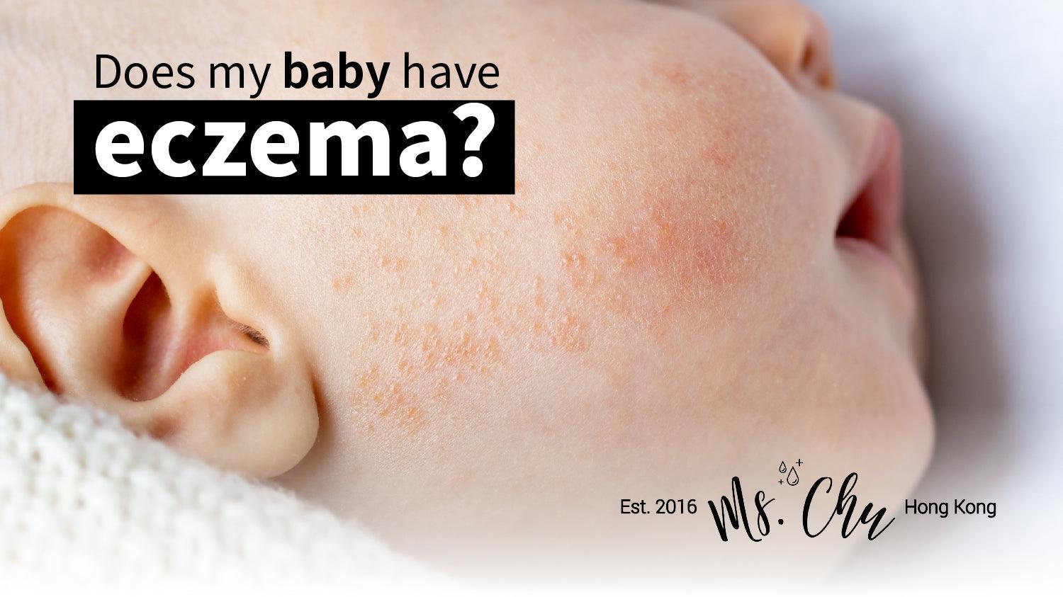 Does my baby have eczema? - Ms. Chu Soap & Beaut