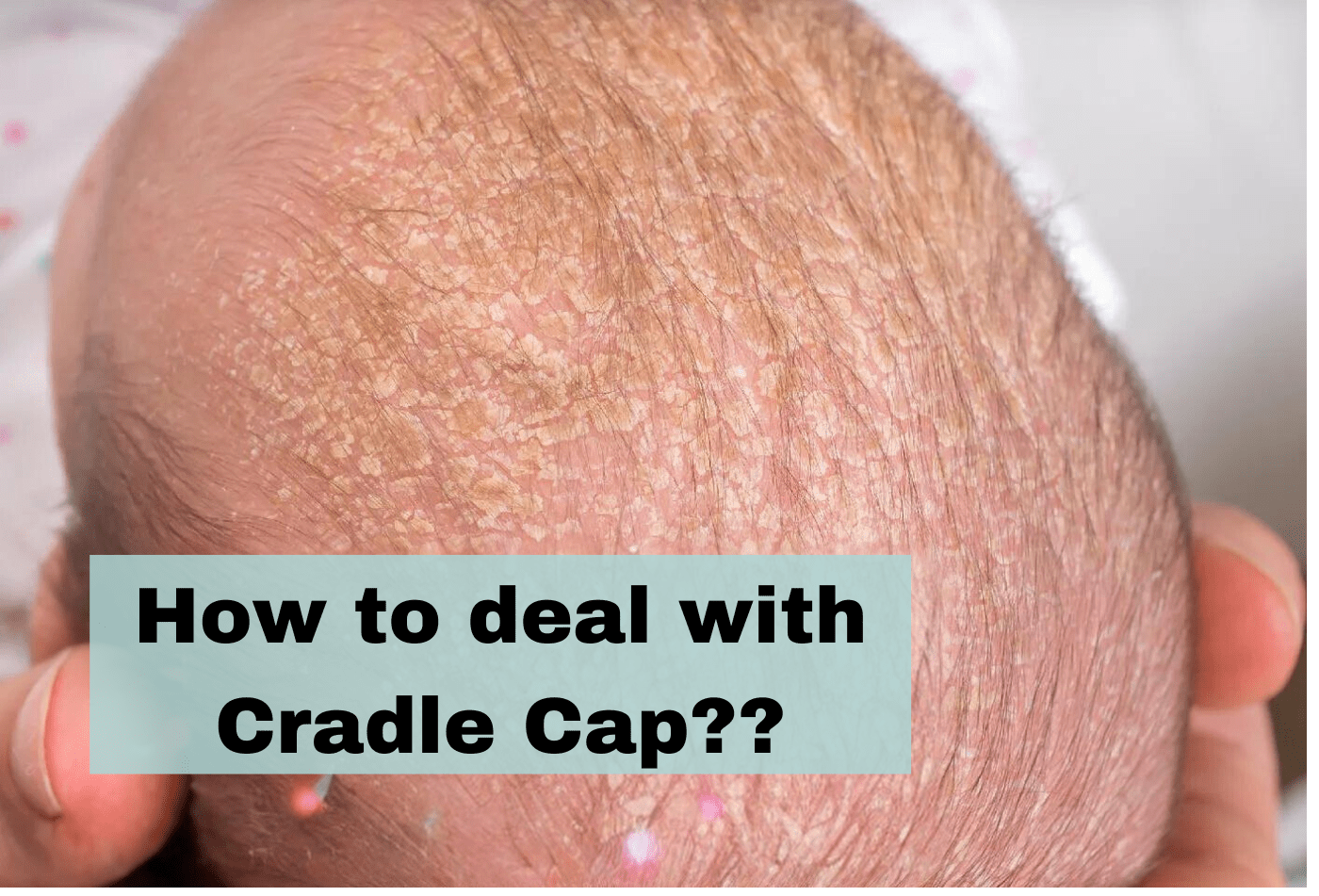 How to deal with baby cradle cap? - Ms. Chu Soap & Beaut