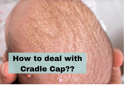 How to deal with baby cradle cap?